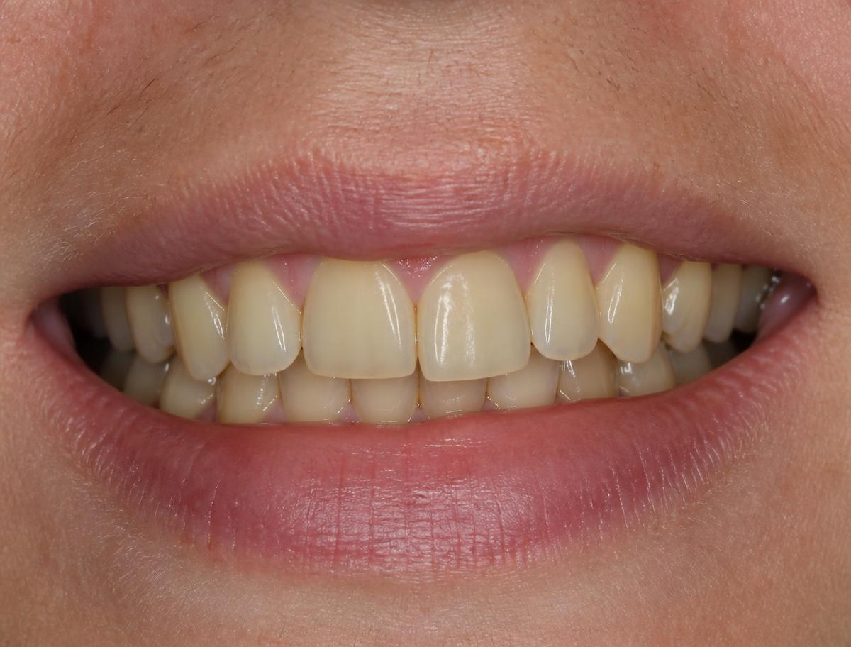 Before Full Smile Makeover at SmileCraft Dental Studio